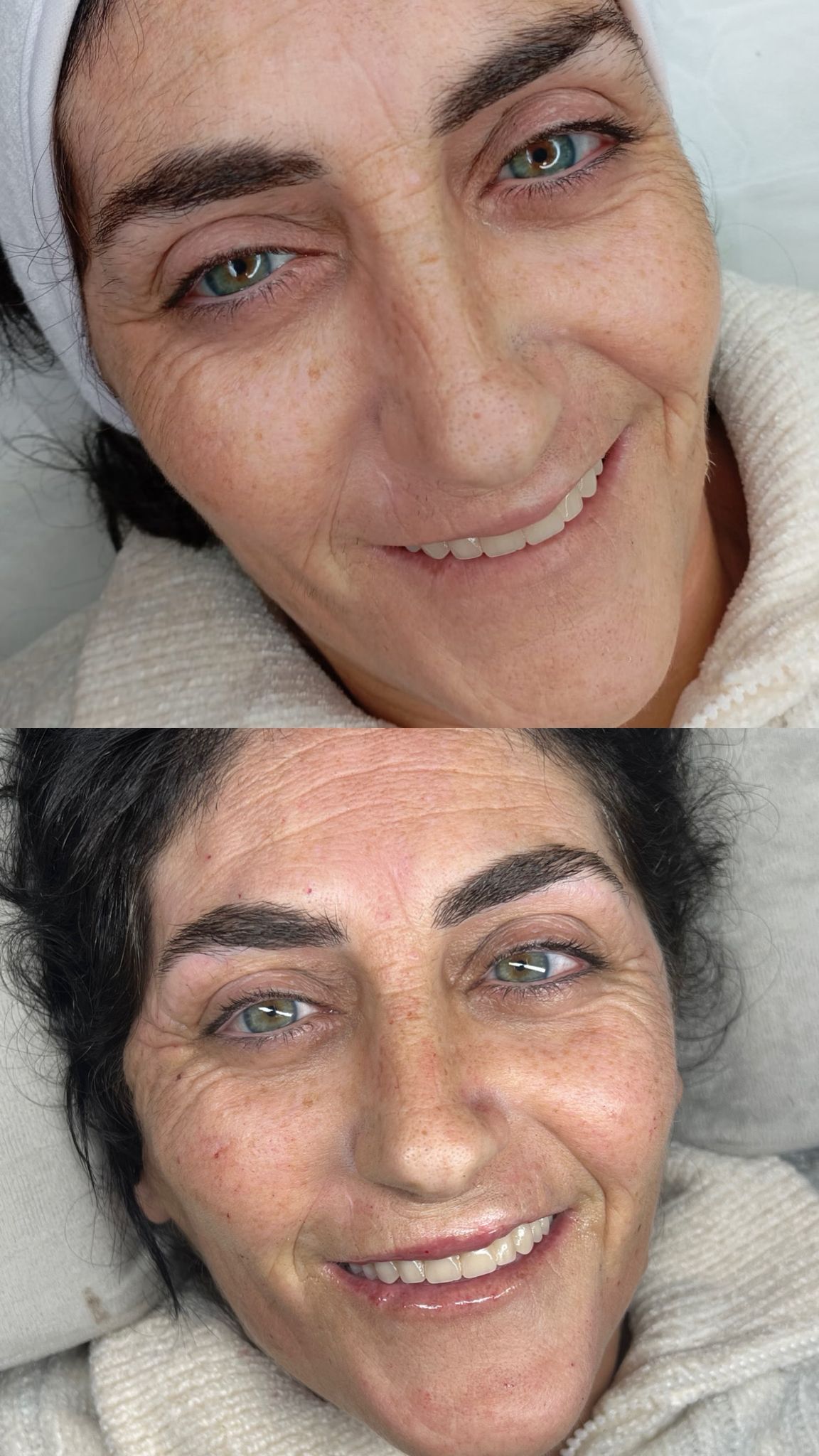 Resultado skinbooster rejuvenescimento MÍRAME