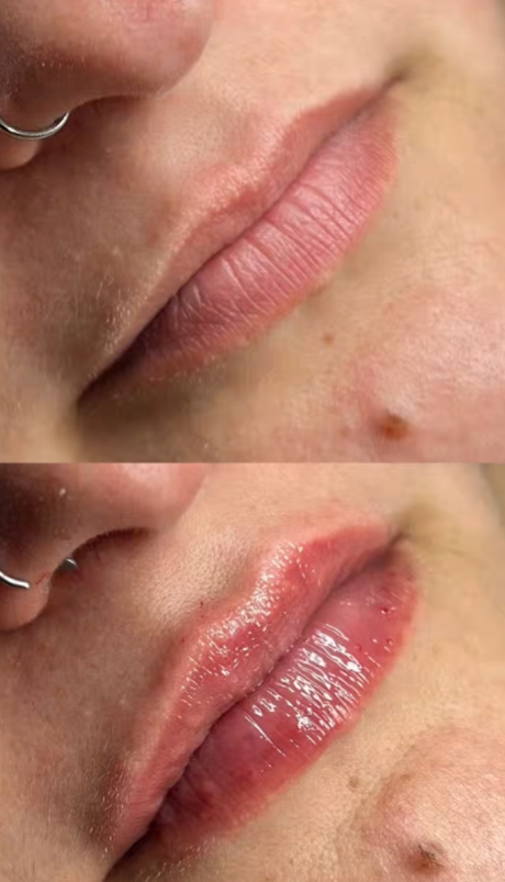Resultado volume labial antes depois MÍRAME